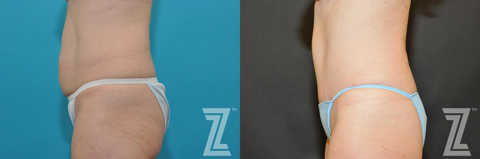 Austin Tummy Tuck Before & After Gallery - Patient 132886891 - Image 2 - The Piazza Center