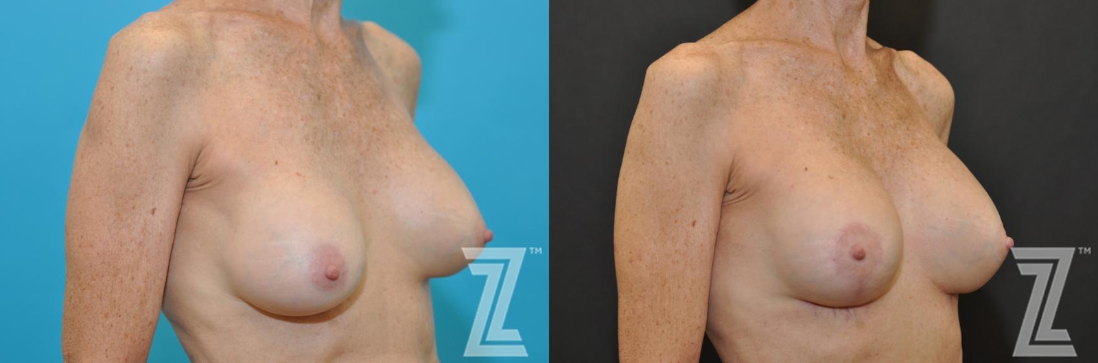 Austin Breast Augmentation Revision Before & After Gallery - Patient 132793347 - Image 4 - The Piazza Center