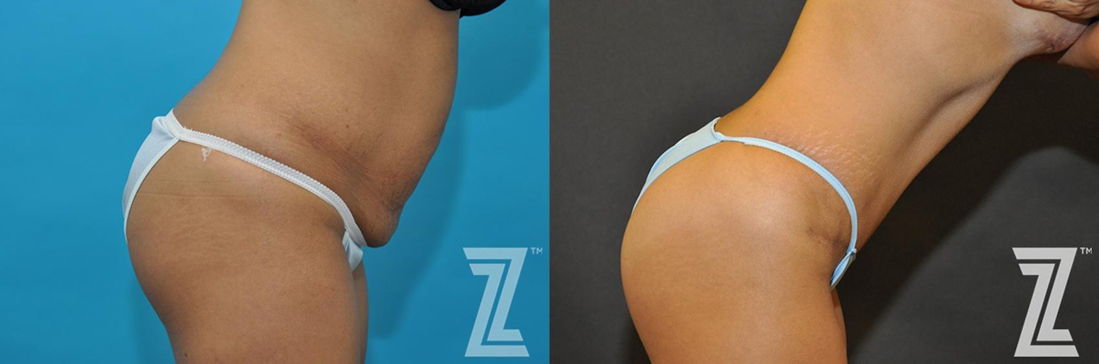 Austin Tummy Tuck Before & After Gallery - Patient 132886888 - Image 5 - The Piazza Center