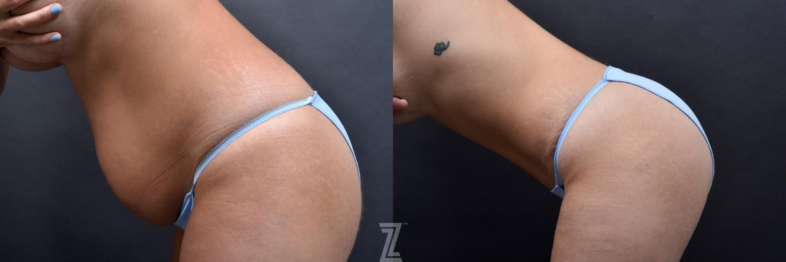 Austin Tummy Tuck Before & After Gallery - Patient 132886801 - Image 3 - The Piazza Center