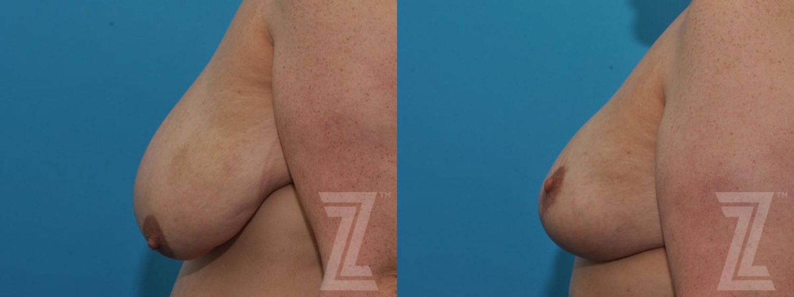 Austin Breast Reduction Before & After Gallery - Patient 132886599 - Image 3 - The Piazza Center