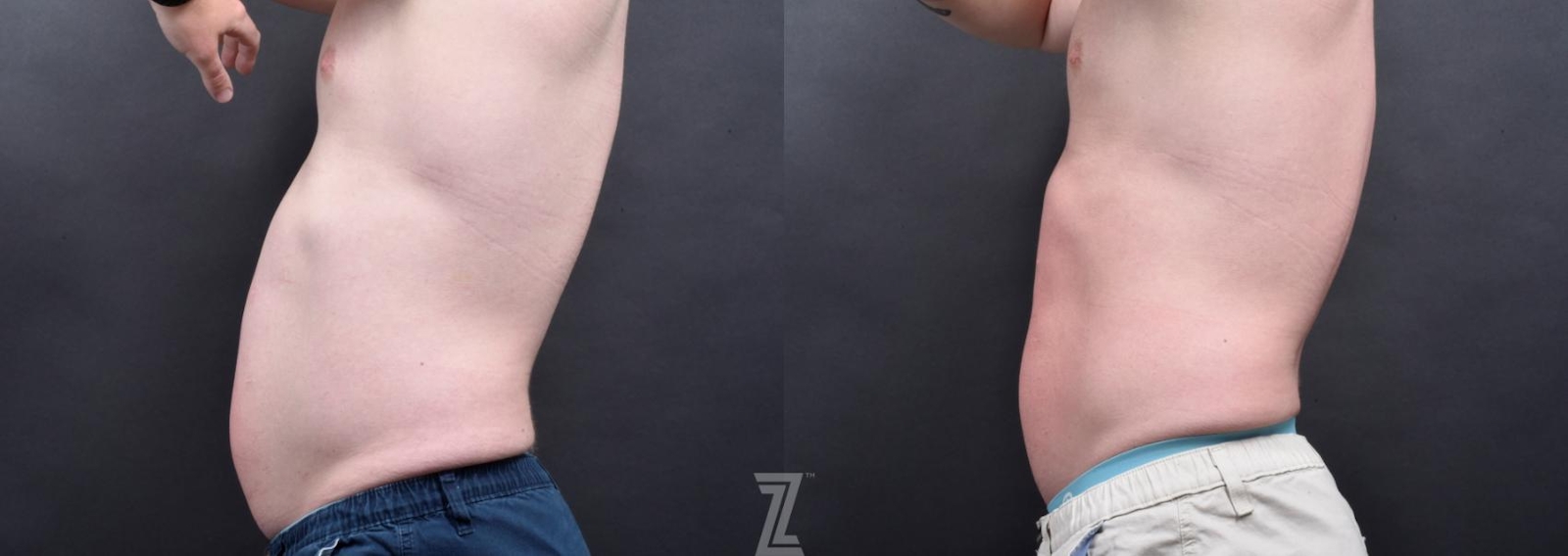 Austin Emsulpt Neo® Before & After Gallery - Patient 132905398 - Image 2 - The Piazza Center
