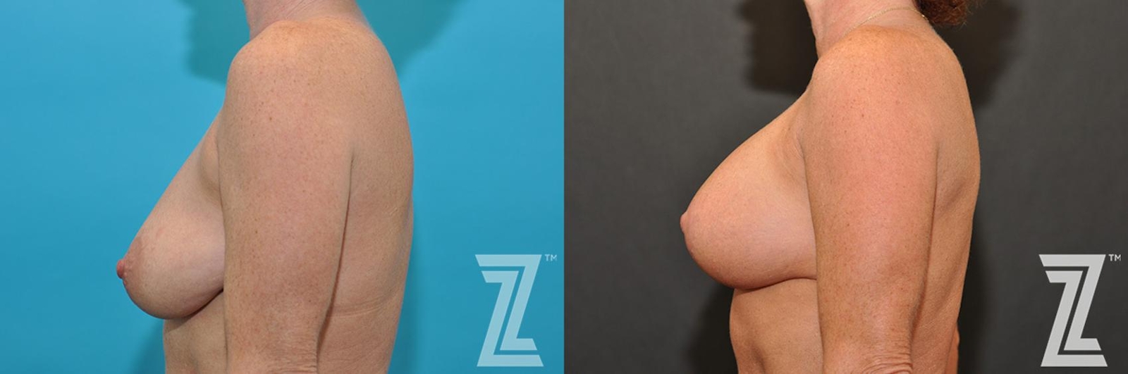 Austin Breast Augmentation With a Breast Lift Before & After Gallery - Patient 132791107 - Image 3 - The Piazza Center