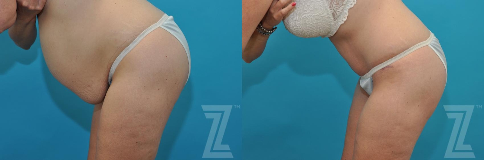 Austin Tummy Tuck Before & After Gallery - Patient 132886822 - Image 3 - The Piazza Center