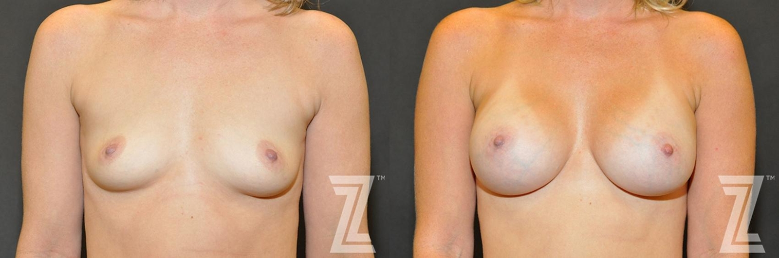 Austin Frontal view before & after images of 35-year-old mother of two 8 month post op breast augmentation - Dr. Rocco Piazza - The Piazza Center