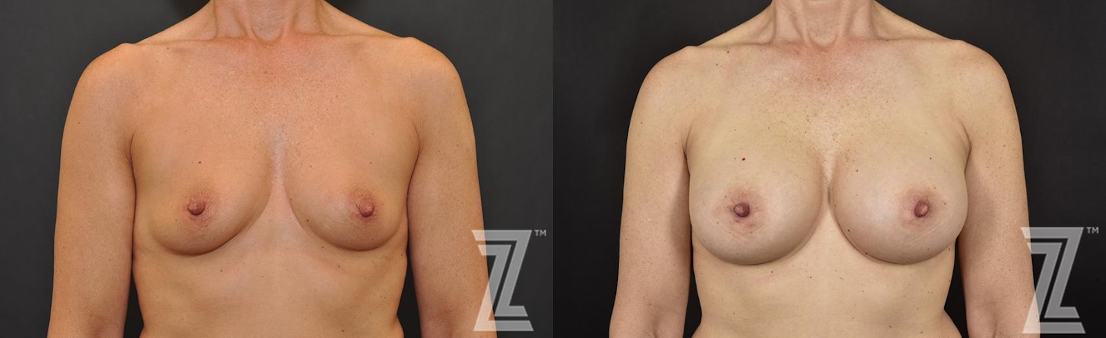 Austin 53 Year Old 3 year Post-OP Breast Augmentation Before & After in Austin, TX - The Piazza Center - Lateral View - The Piazza Center