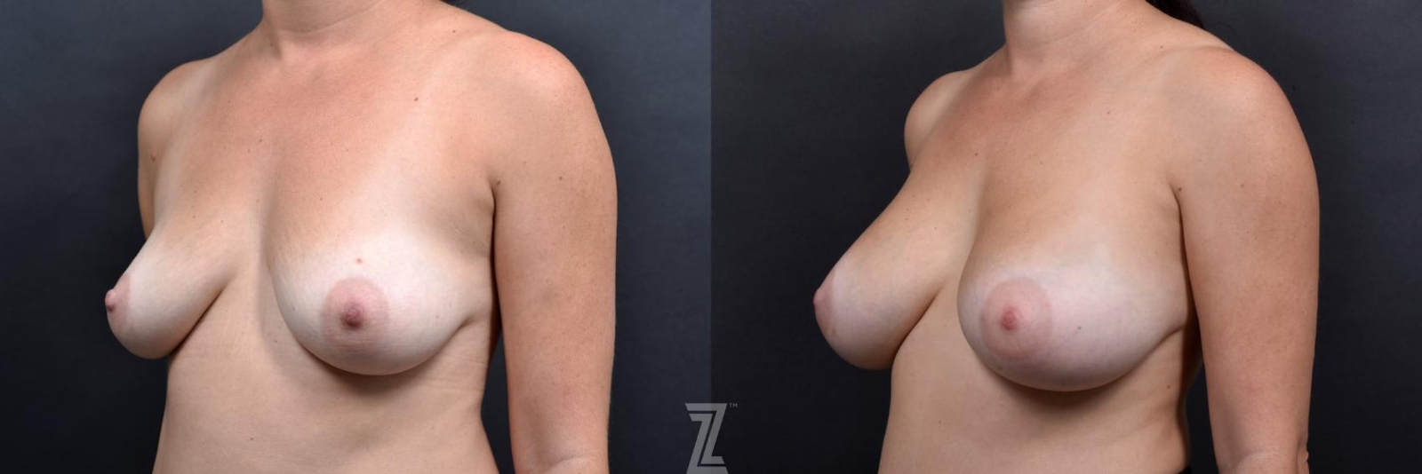 Austin Oblique view of 36 year old woman with Silicone Implants with Cohesive Silicone Gel at the Piazza Center - The Piazza Center