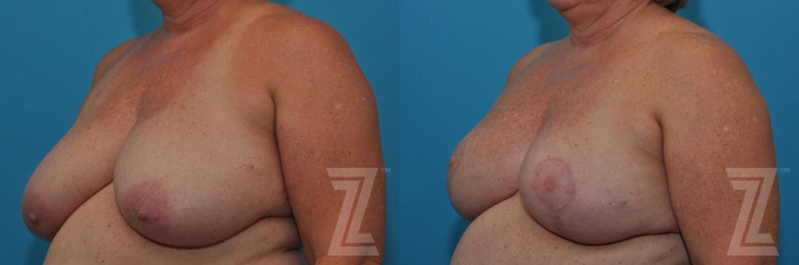 Austin Breast Reduction Before & After Gallery - Patient 132886617 - Image 2 - The Piazza Center