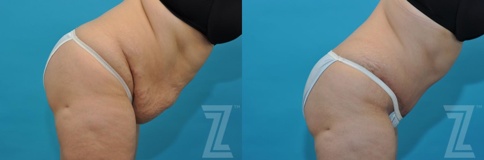 Austin Tummy Tuck Before & After Gallery - Patient 132886829 - Image 5 - The Piazza Center