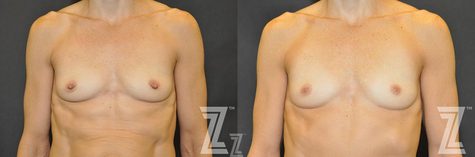 Austin Nipple Reduction Before & After Gallery - Patient 132886785 - Image 5 - The Piazza Center