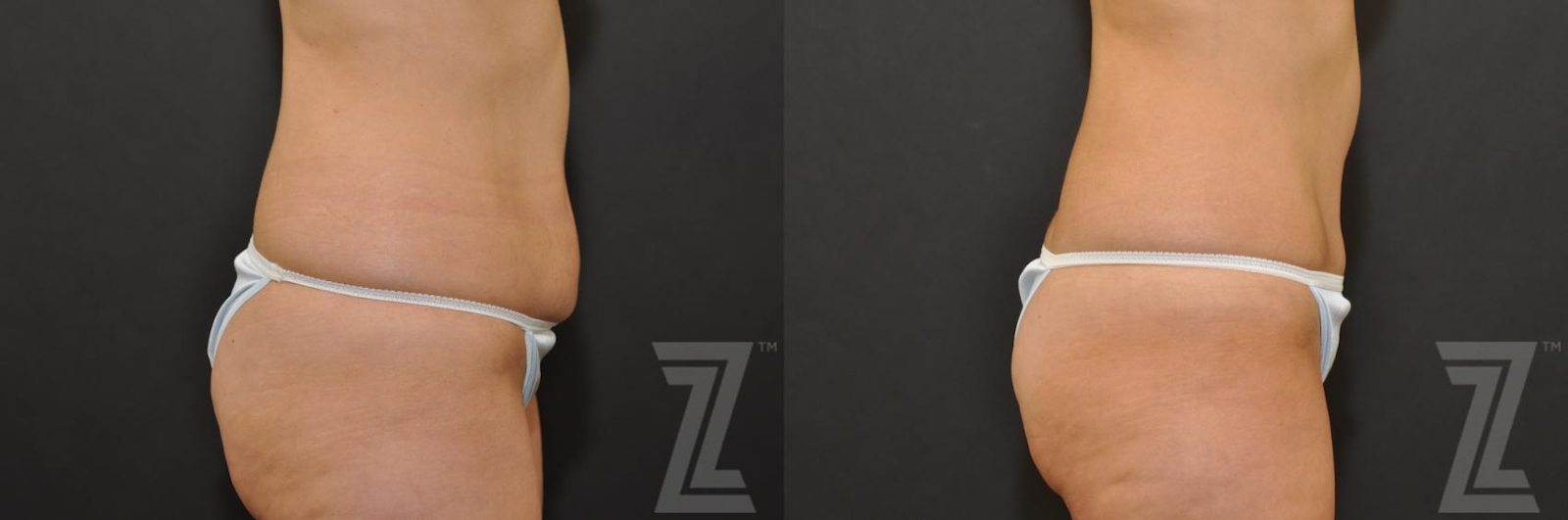 Austin Tummy Tuck Before & After Gallery - Patient 132886896 - Image 4 - The Piazza Center