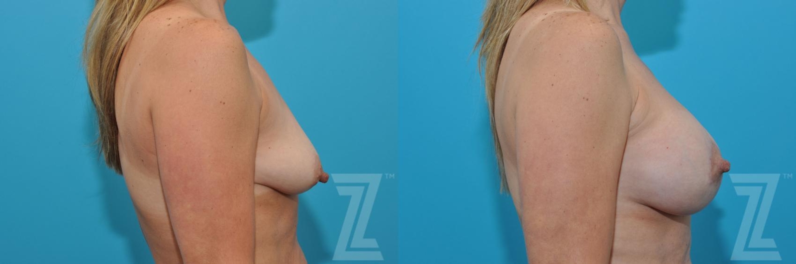 Austin Breast Augmentation With a Breast Lift Before & After Gallery - Patient 132791122 - Image 5 - The Piazza Center