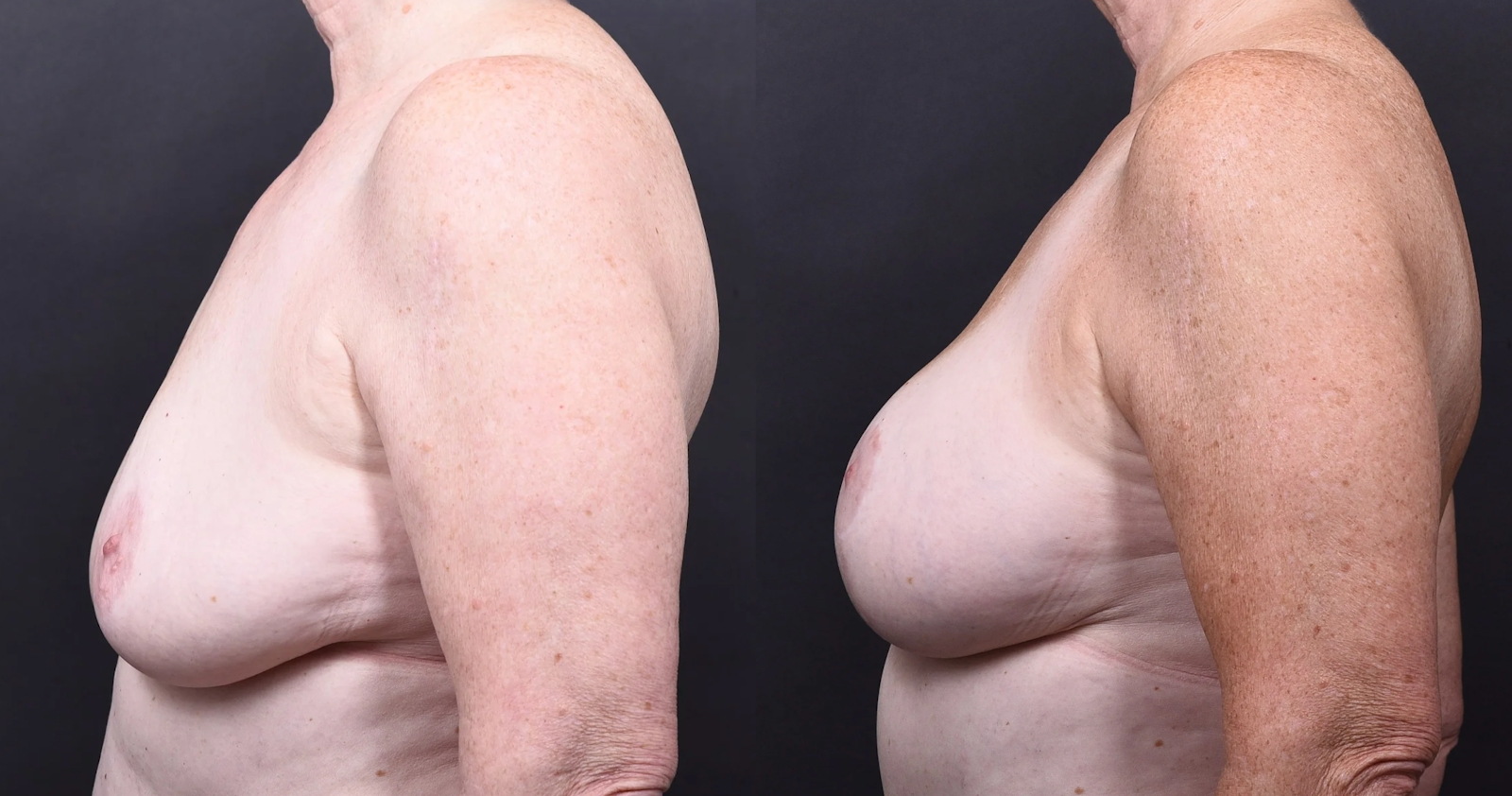 Austin Breast Augmentation With a Breast Lift Before & After Gallery - Patient 438571 - Image 5 - The Piazza Center