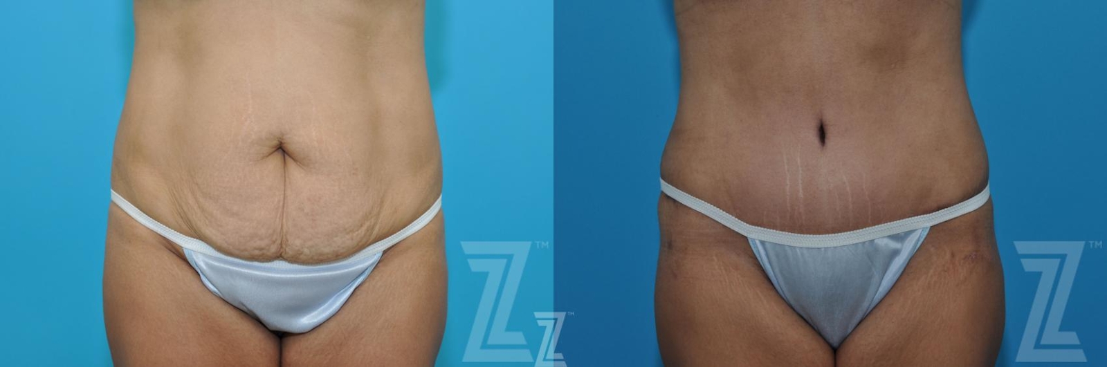 Austin Tummy Tuck Before & After Gallery - Patient 132886898 - Image 1 - The Piazza Center