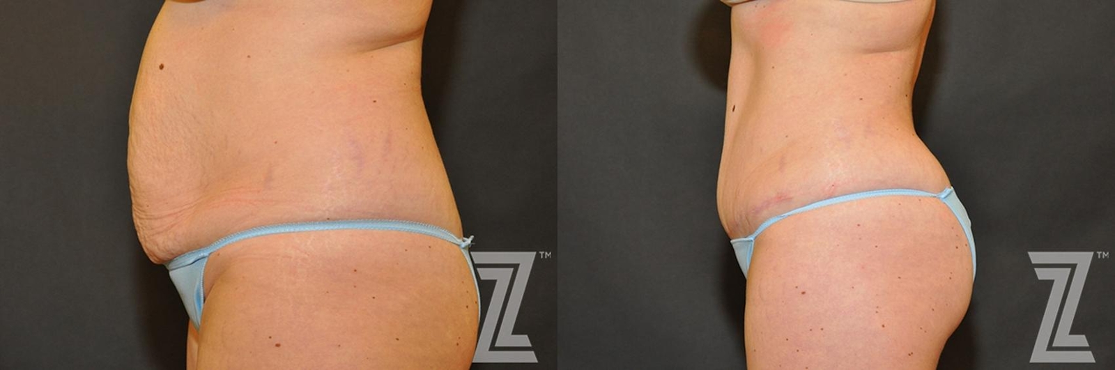 Austin Tummy Tuck Before & After Gallery - Patient 132886883 - Image 2 - The Piazza Center