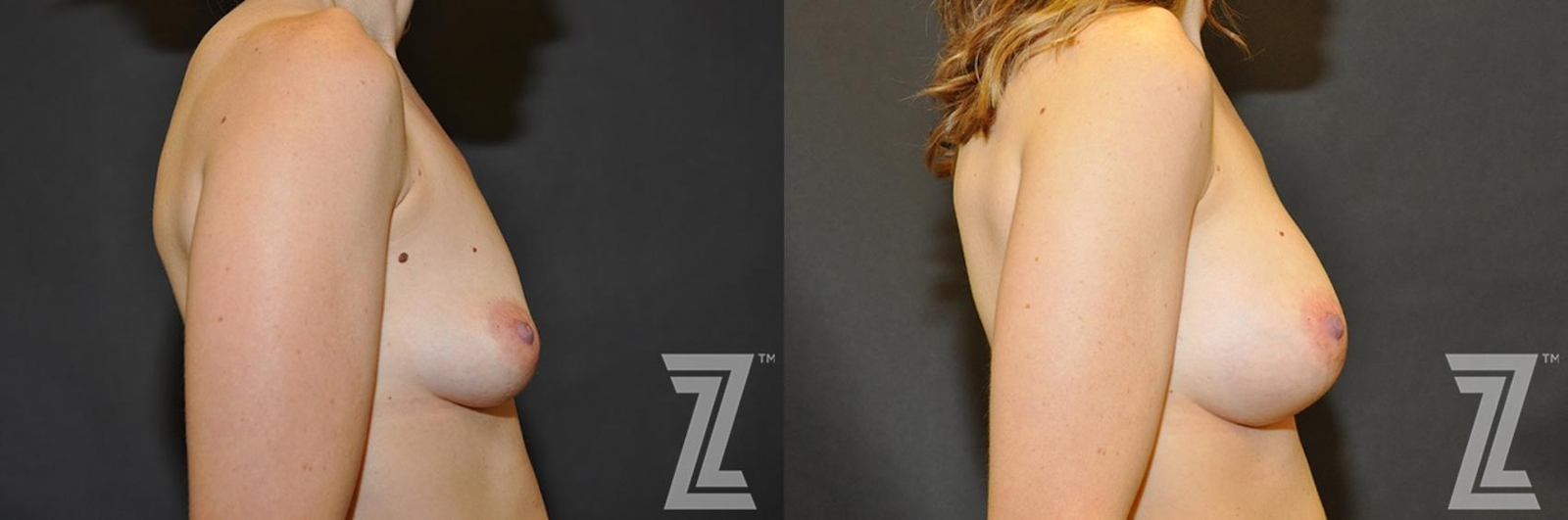Austin Lateral view before & after of 34 year old woman with Silicone Implants with Cohesive Silicone Gel - The Piazza Center - The Piazza Center