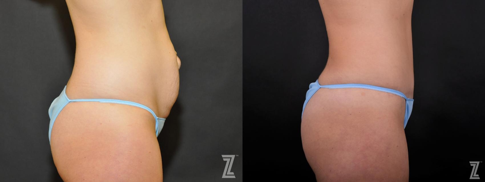 Austin Tummy Tuck Before & After Gallery - Patient 132886895 - Image 4 - The Piazza Center