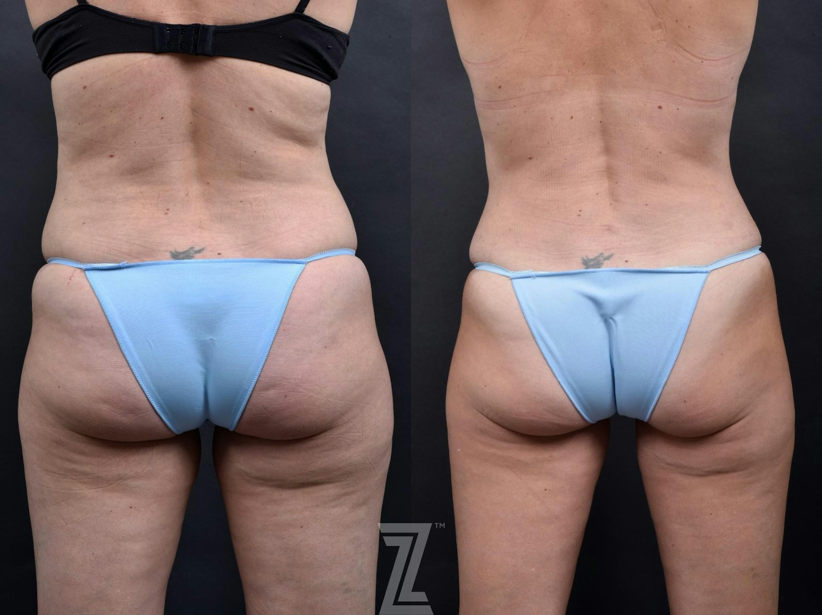 Austin Tummy Tuck Before & After Gallery - Patient 132886865 - Image 6 - The Piazza Center