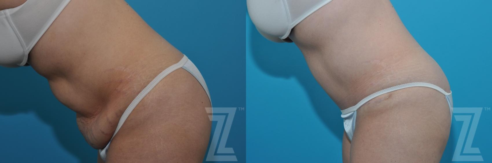 Austin Tummy Tuck Before & After Gallery - Patient 132886869 - Image 3 - The Piazza Center