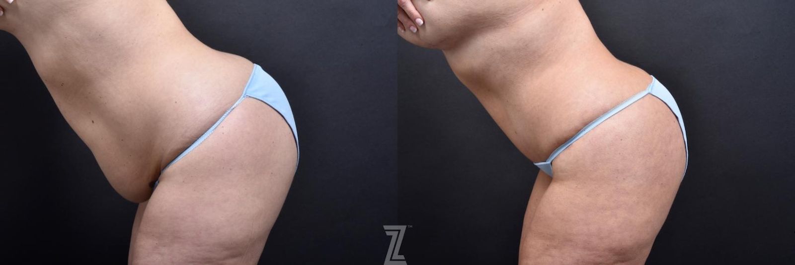 Austin Oblique Flexion View from Mommy Makeover of 41 year old woman in Austin, TX by Dr. Rocco Piazza - Before & After - The Piazza Center