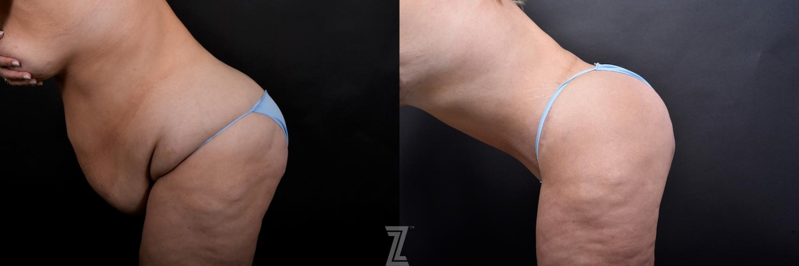 Austin Tummy Tuck Before & After Gallery - Patient 132886815 - Image 3 - The Piazza Center