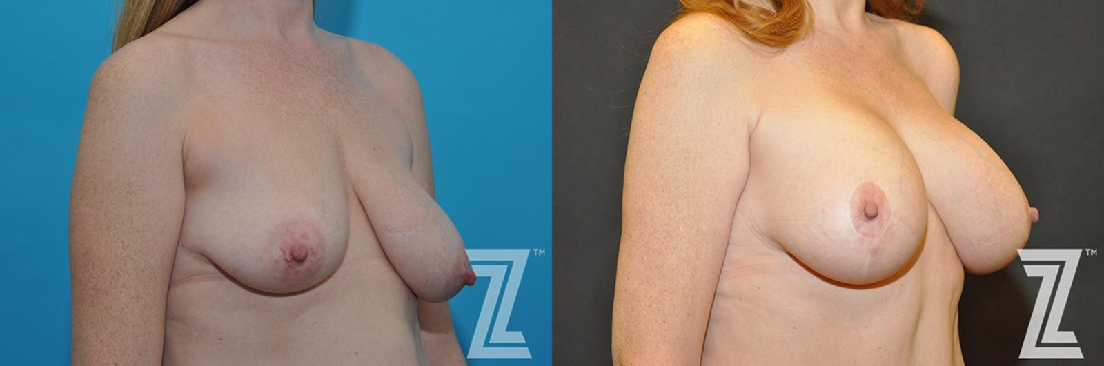 Austin Correction of Breast Asymmetry Before & After Gallery - Patient 132886778 - Image 4 - The Piazza Center