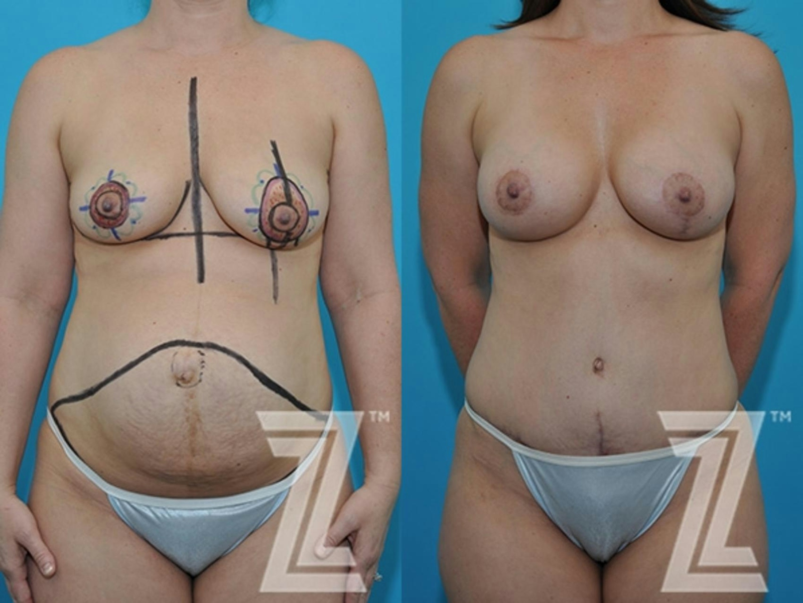 Austin Full Frontal view before & after 3 month post op 39 year old woman mommy make over - The Piazza Center, Austin TX - The Piazza Center