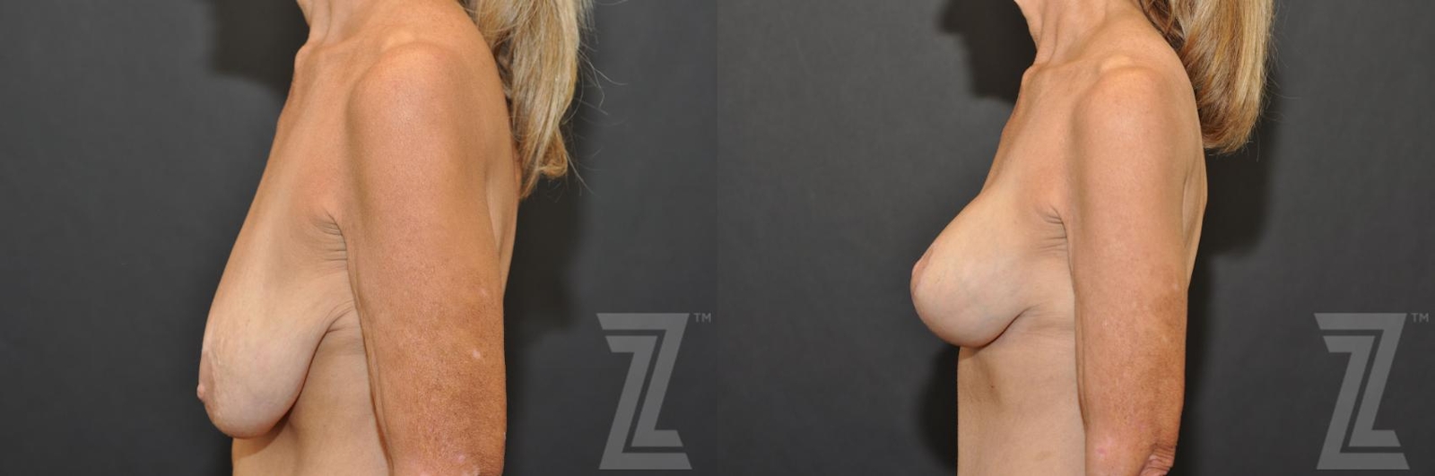 Austin Breast Augmentation With a Breast Lift Before & After Gallery - Patient 132793339 - Image 3 - The Piazza Center