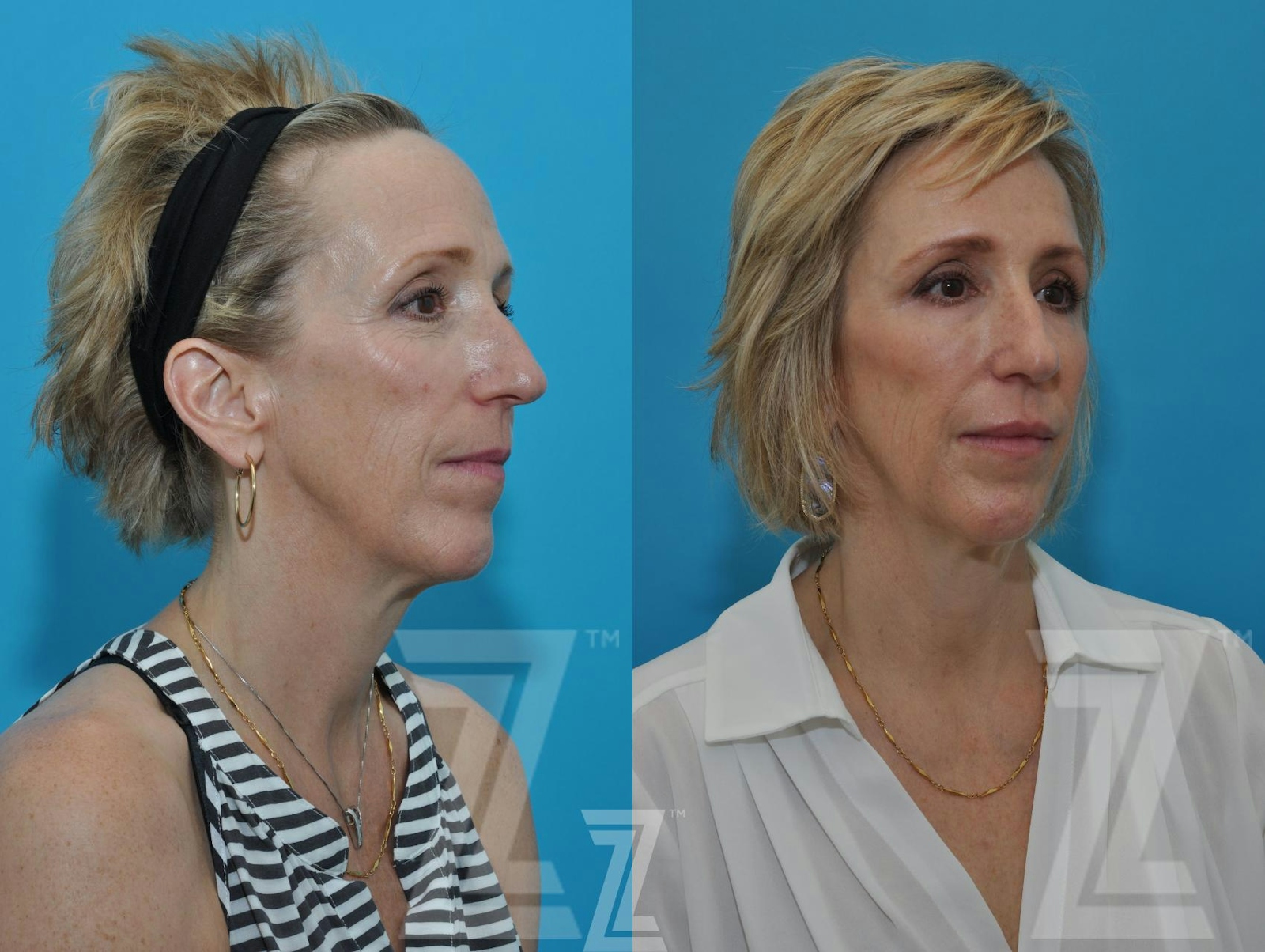 Austin Injectable Fillers Before & After Gallery - Patient 132963096 - Image 4 - The Piazza Center