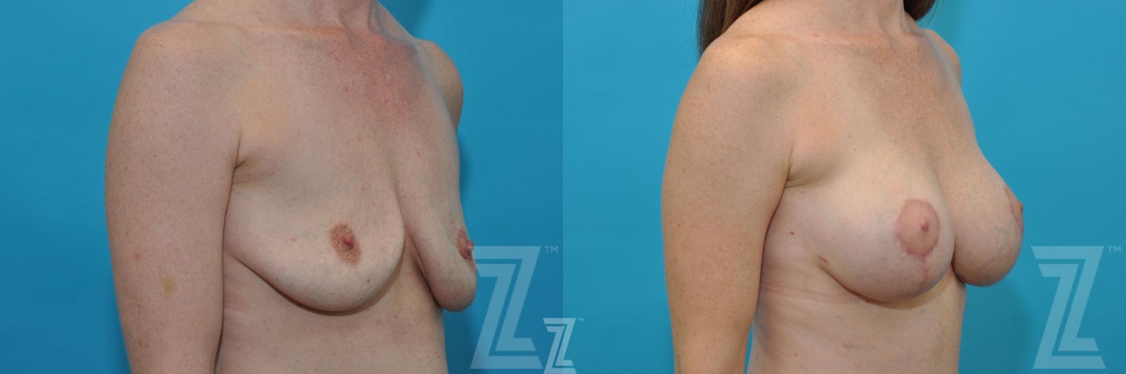 Austin before & after oblique view images of breasts of 35 year old woman mommy make over - Dr. Rocco Piazza Austin TX - The Piazza Center