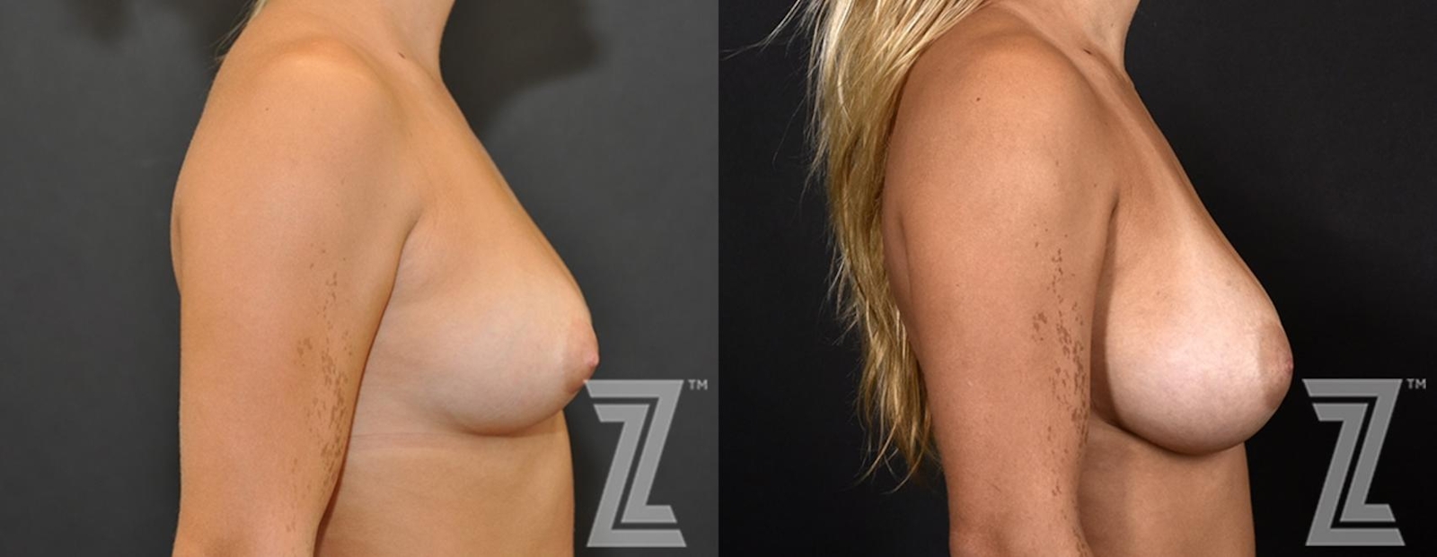 Austin Side view of before and after 2 year post op 23 year old woman with breast augmentation - The Piazza Center