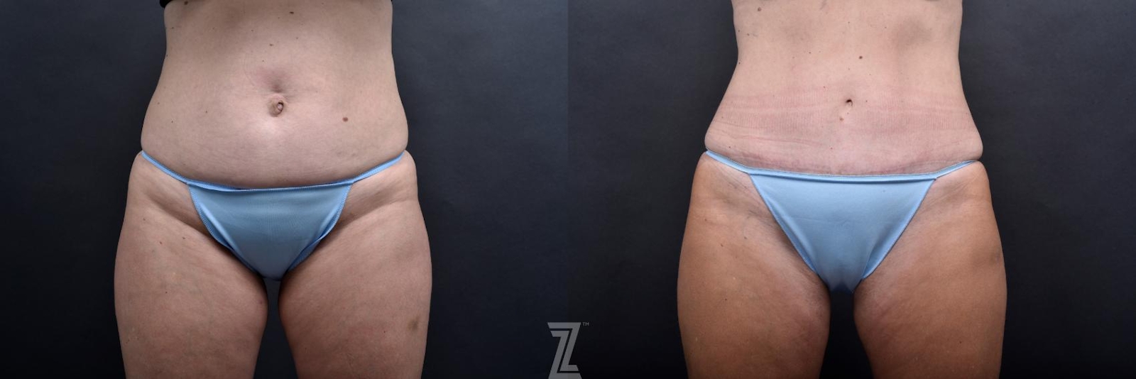 Austin Tummy Tuck Before & After Gallery - Patient 132886865 - Image 1 - The Piazza Center