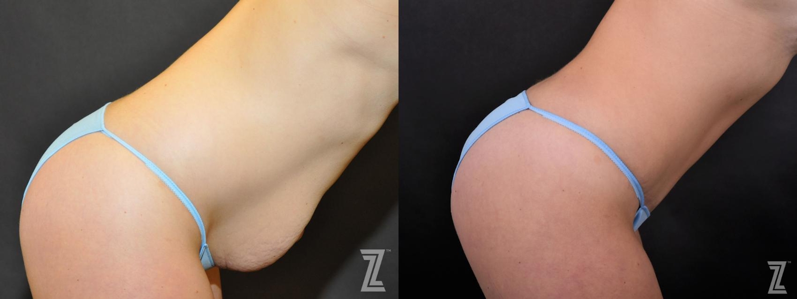 Austin Tummy Tuck Before & After Gallery - Patient 132886895 - Image 5 - The Piazza Center