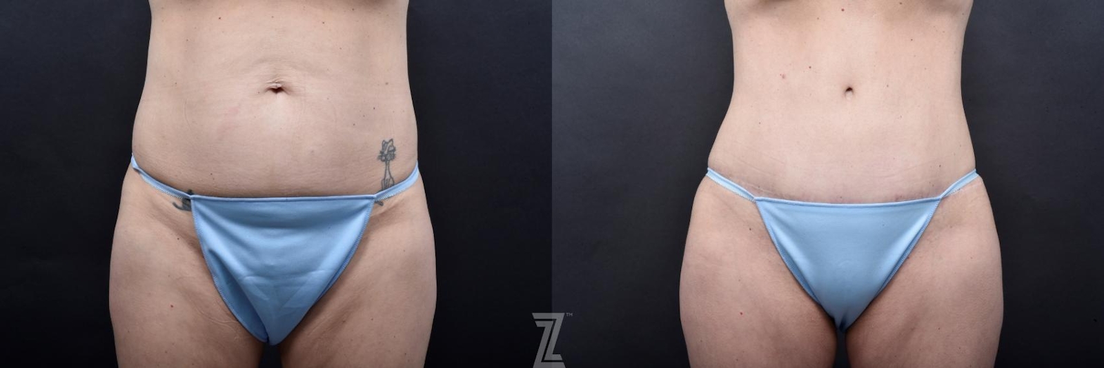 Austin Tummy Tuck Before & After Gallery - Patient 132886820 - Image 1 - The Piazza Center