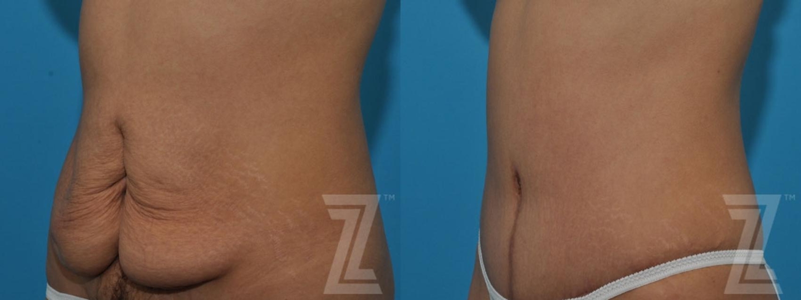 Austin Tummy Tuck Before & After Gallery - Patient 132886797 - Image 2 - The Piazza Center