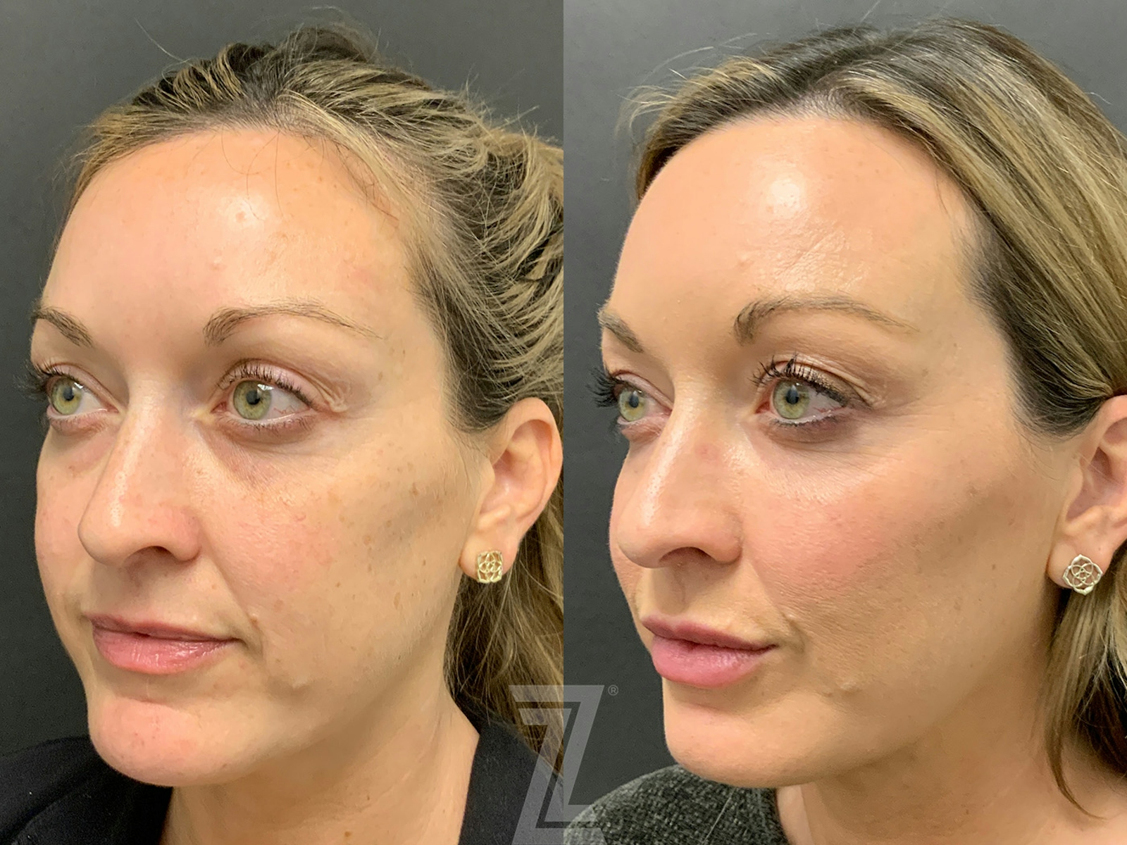 Austin Facial Rejuvenation Before & After Gallery - Patient 184295 - Image 2 - The Piazza Center