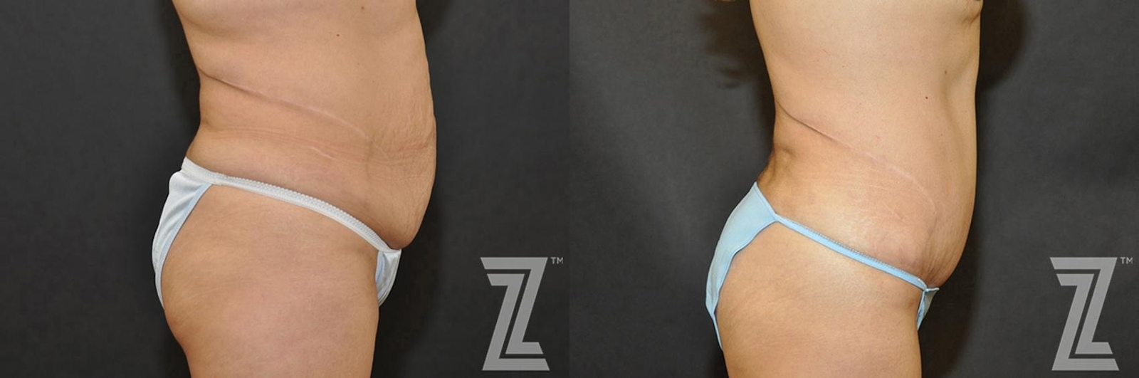 Austin Tummy Tuck Before & After Gallery - Patient 132886902 - Image 5 - The Piazza Center