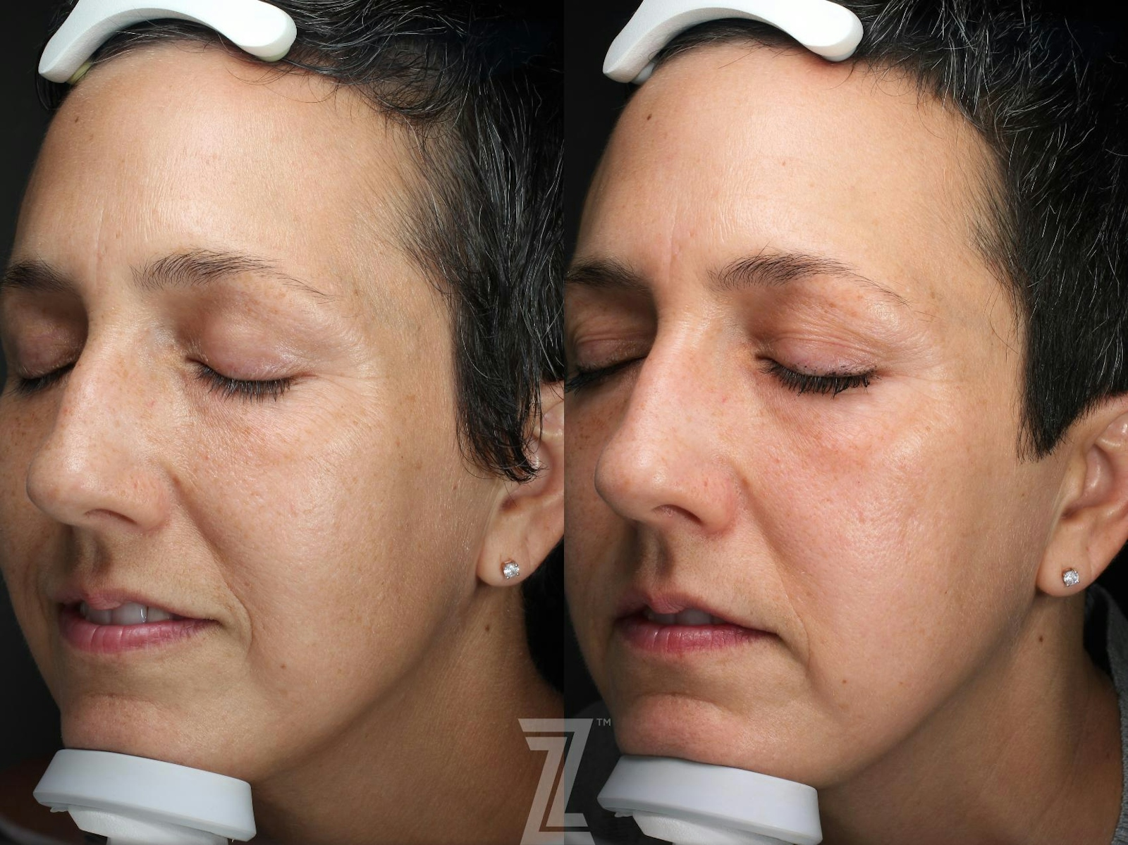 Austin HALO Before & After Gallery - Patient 386324 - Image 3 - The Piazza Center