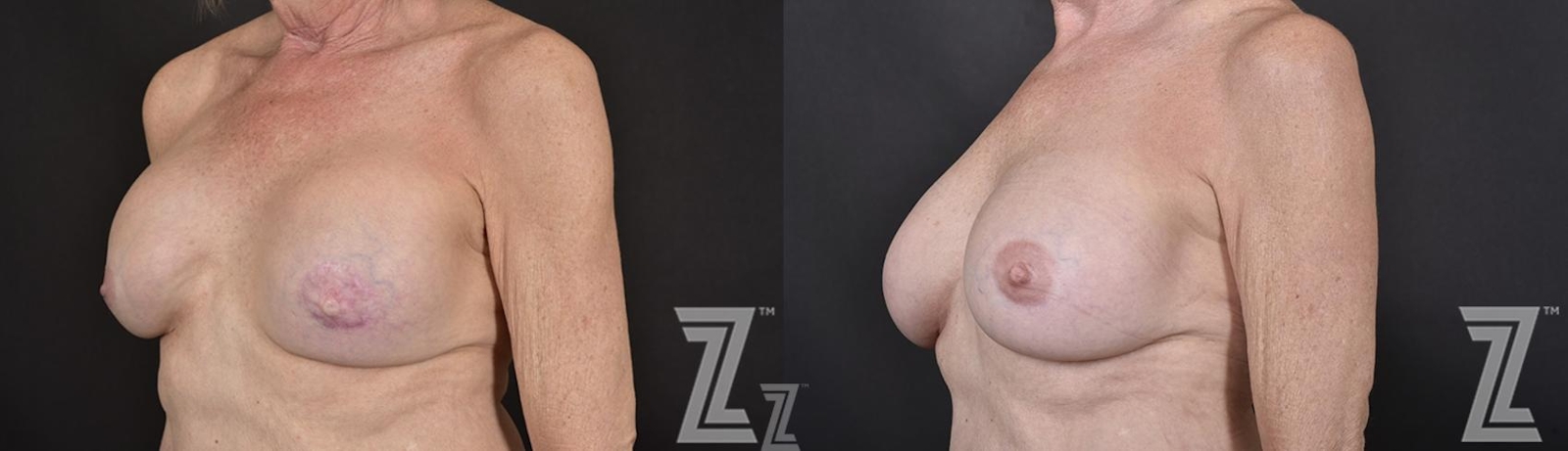 Austin Breast Reconstruction Before & After Gallery - Patient 132886765 - Image 2 - The Piazza Center