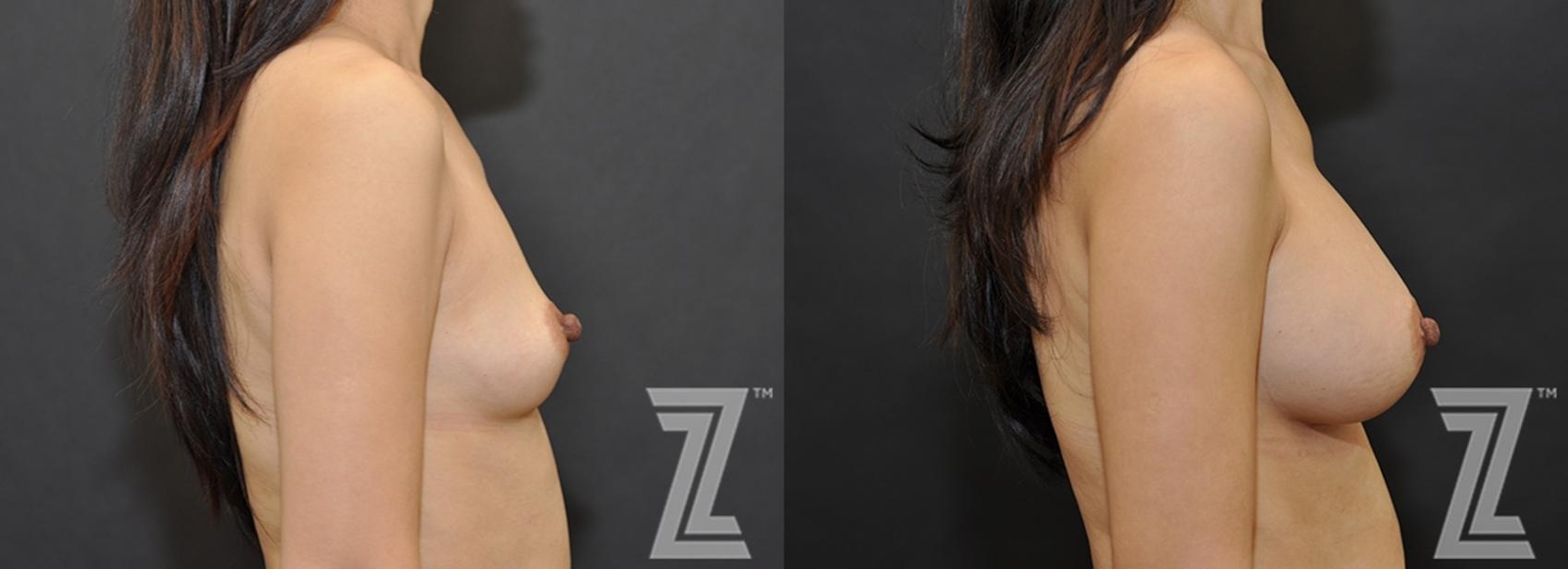 Austin Lateral view of Before & After image of woman with Silicone Implants with Highly Cohesive Gel (Gummy Bear Implants) - The Piazza Center