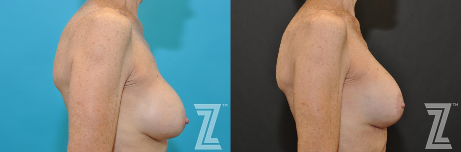 Austin Breast Augmentation Revision Before & After Gallery - Patient 132793347 - Image 5 - The Piazza Center