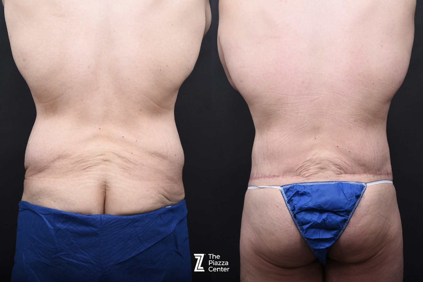 Austin Tummy Tuck Before & After Gallery - Patient 346471 - Image 6 - The Piazza Center