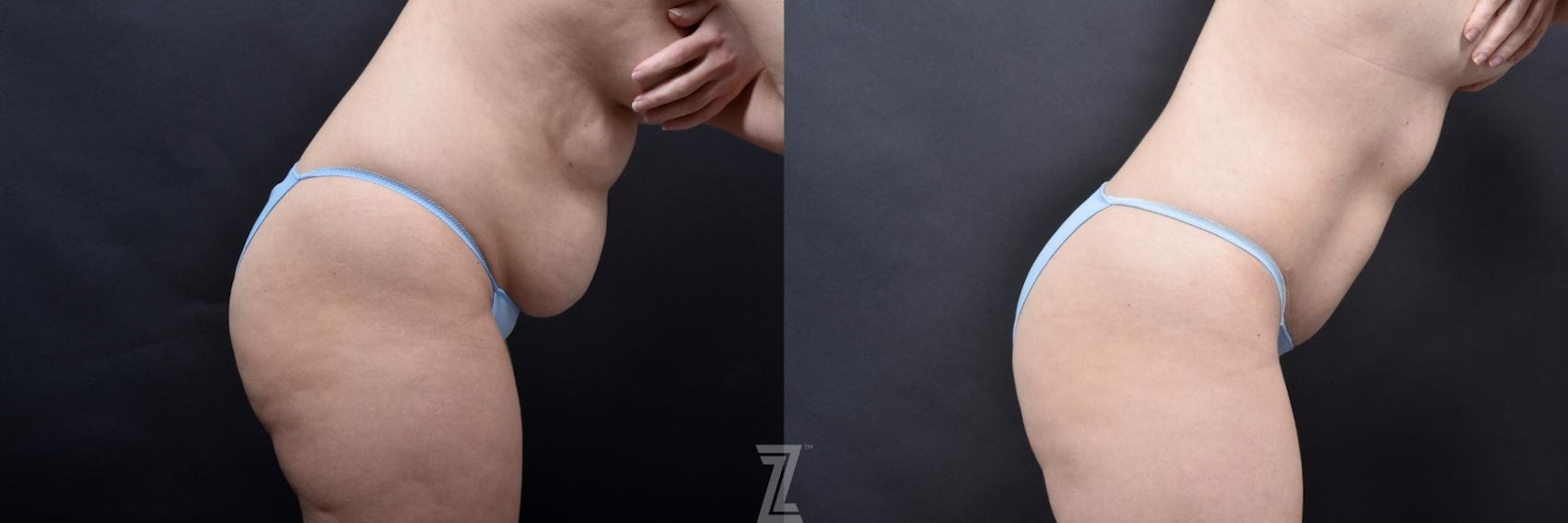 Austin Skin Pinch Before & After Gallery - Patient 132886936 - Image 5 - The Piazza Center