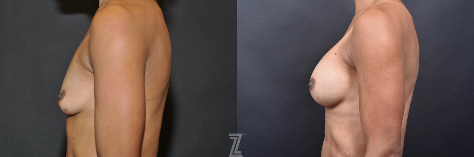 Austin Side view before & after images of 35-year-old mother with breat augmentation - Dr. Rocco Piazza - The Piazza Center