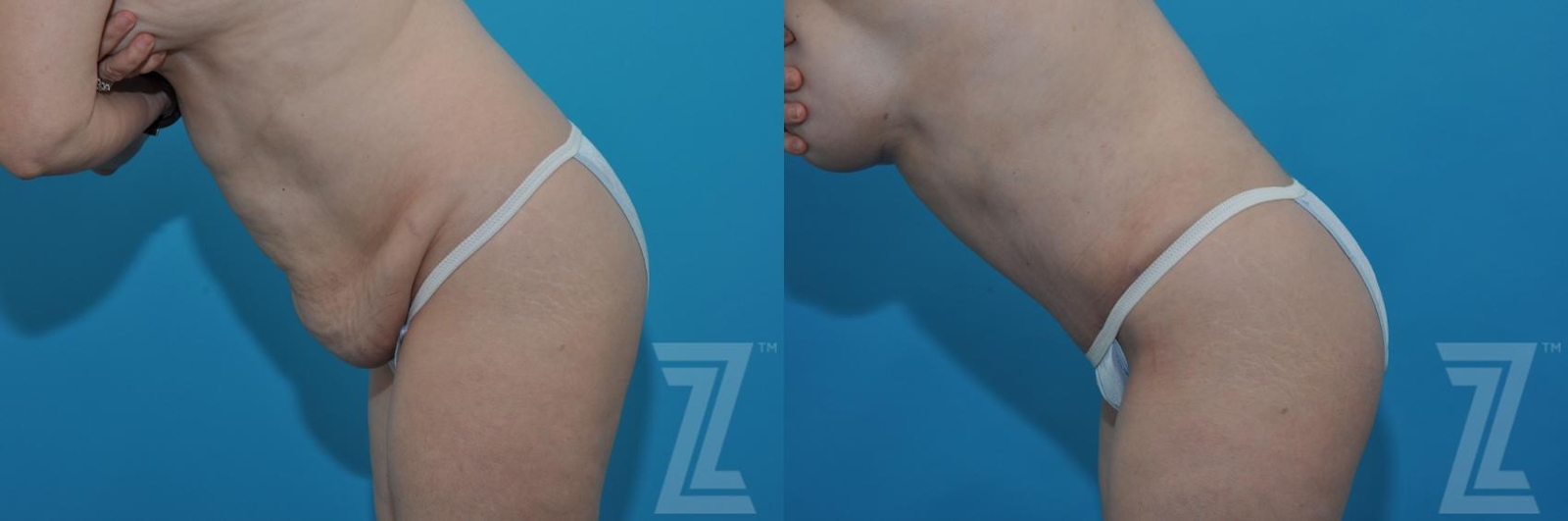 Austin Tummy Tuck Before & After Gallery - Patient 132886813 - Image 3 - The Piazza Center