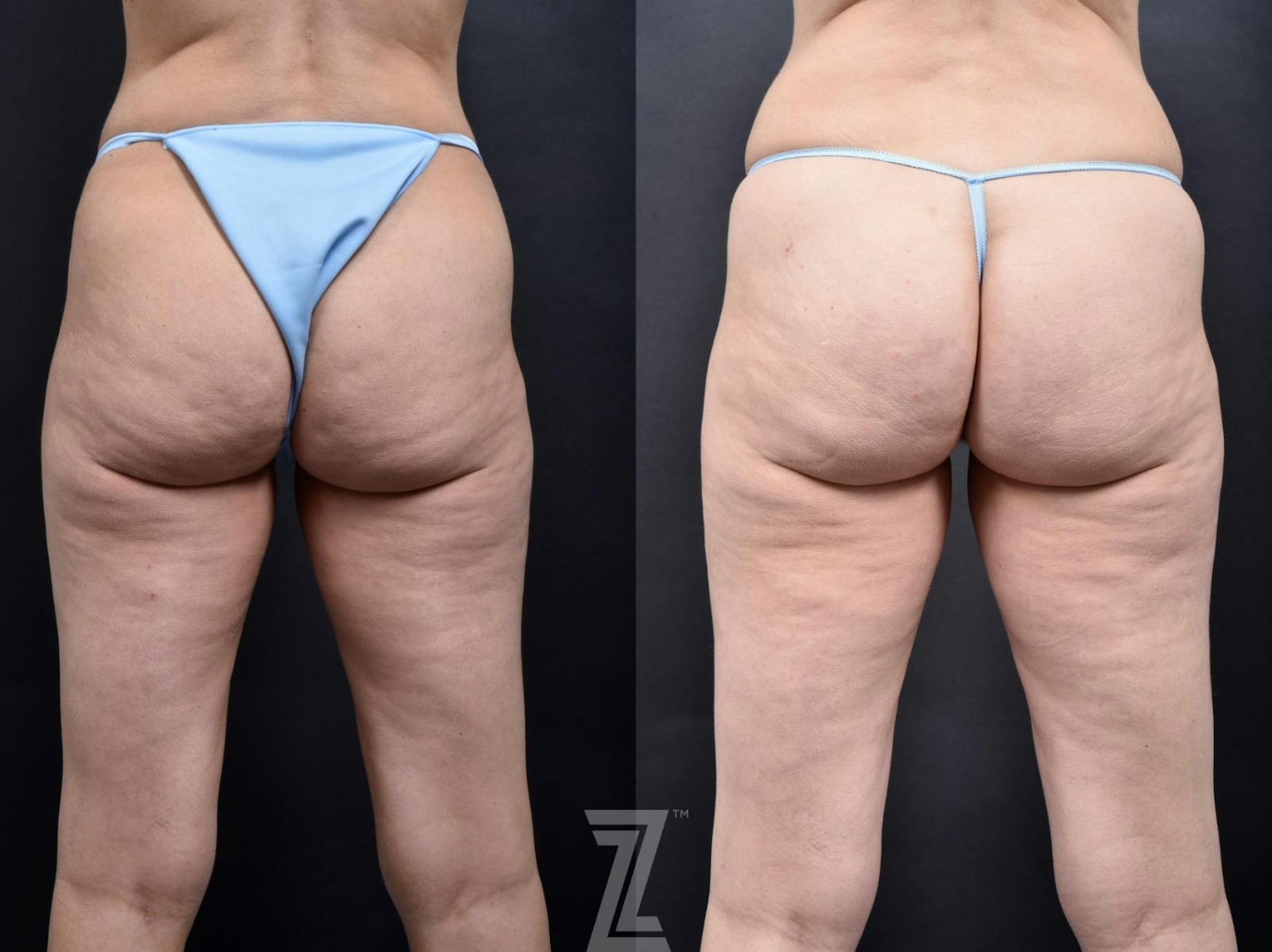 Austin Avéli Before & After Gallery - Patient 132905407 - Image 1 - The Piazza Center