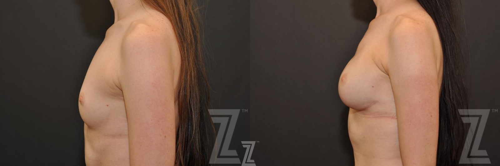 Austin Breast Reconstruction Before & After Gallery - Patient 132886774 - Image 3 - The Piazza Center