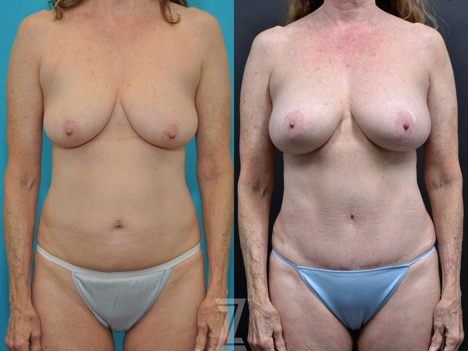 Austin Frontal full body view 7 year post op mommy makeover - The Piazza Center, Austin Tx - The Piazza Center