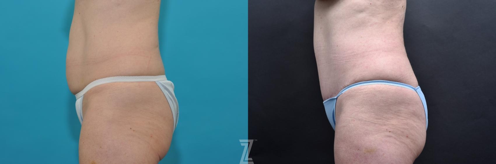 Austin Lateral abdominal view 7 year post op mommy makeover - The Piazza Center, Austin Tx - The Piazza Center