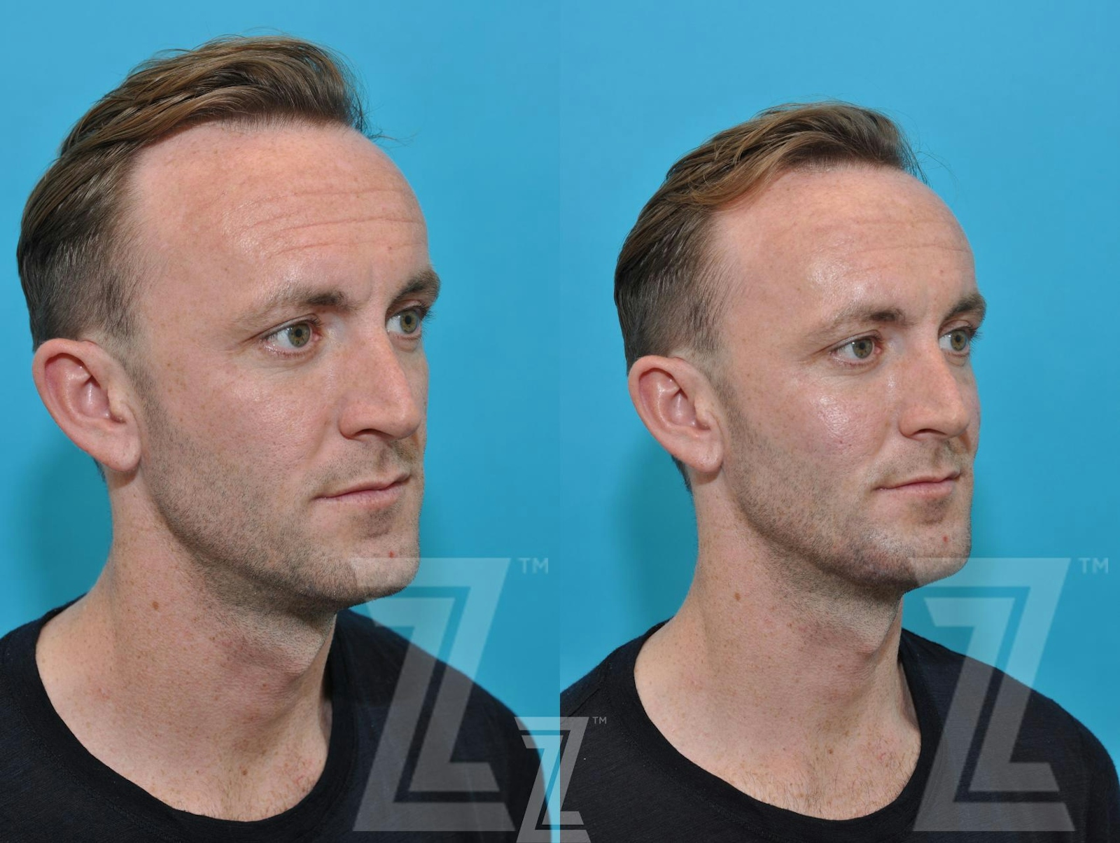 Austin Injectable Fillers Before & After Gallery - Patient 132963102 - Image 4 - The Piazza Center